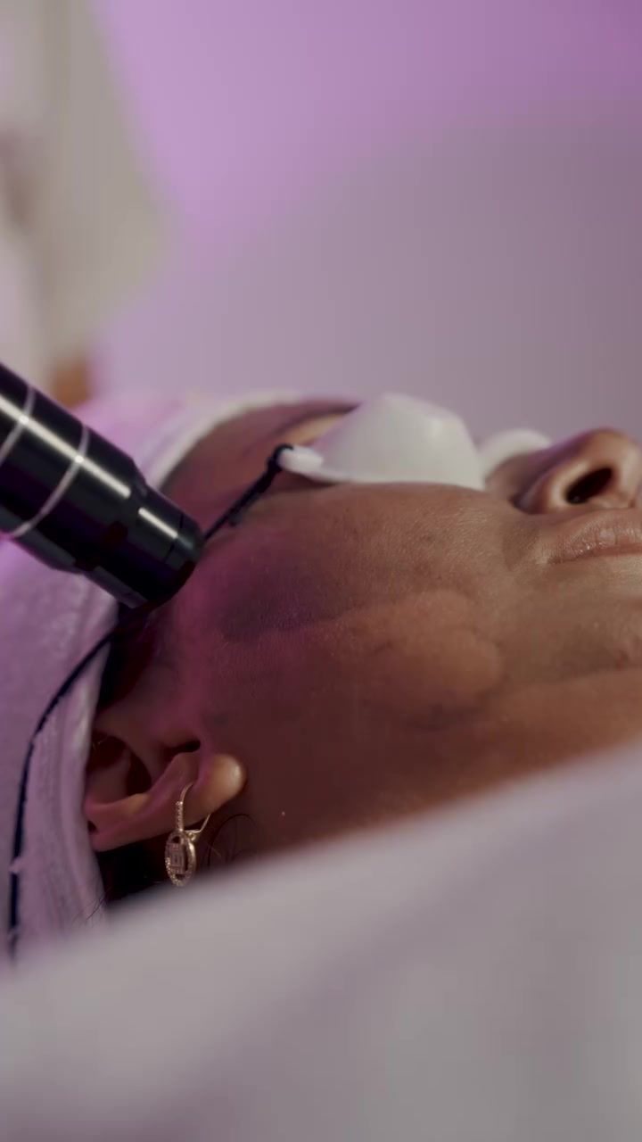 Cilt yenileme için dermapen uygulaması