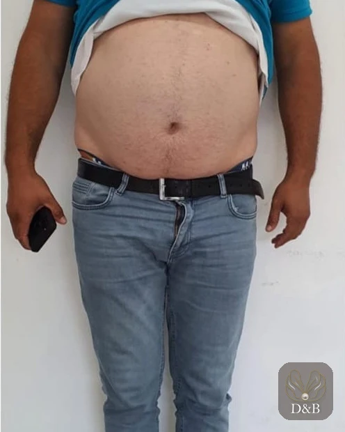 Erkek karın bölgesi önden, bölgesel incelme öncesi ve sonrası — önce